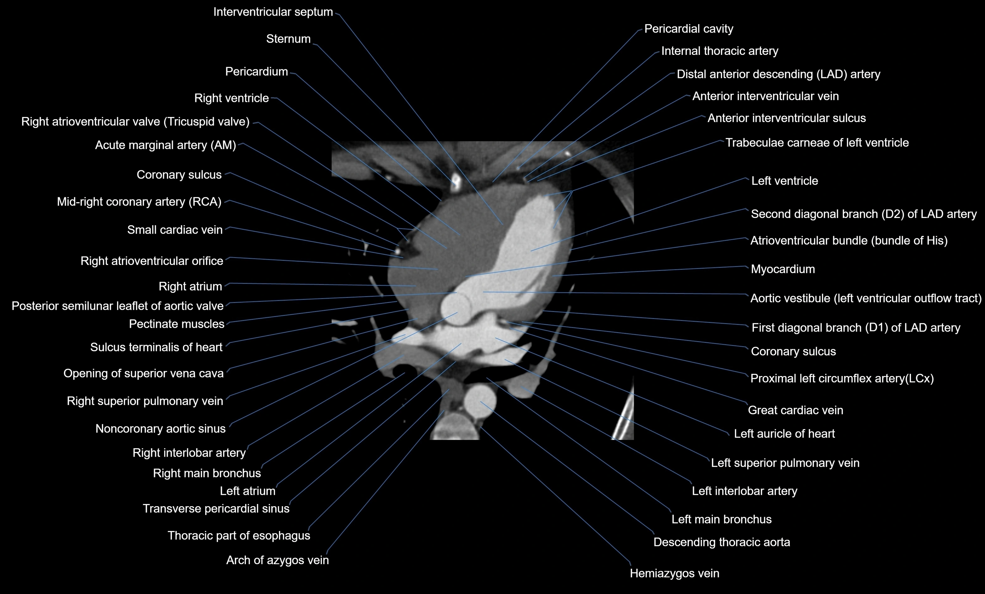 CT heart (coronary angiogram) four chamber view  cross sectional anatomy labelled radiology image -00025.webp